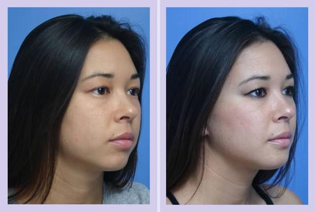 Chin Implant result at Dr. Anthony S. Youn, MD in Troy, MI