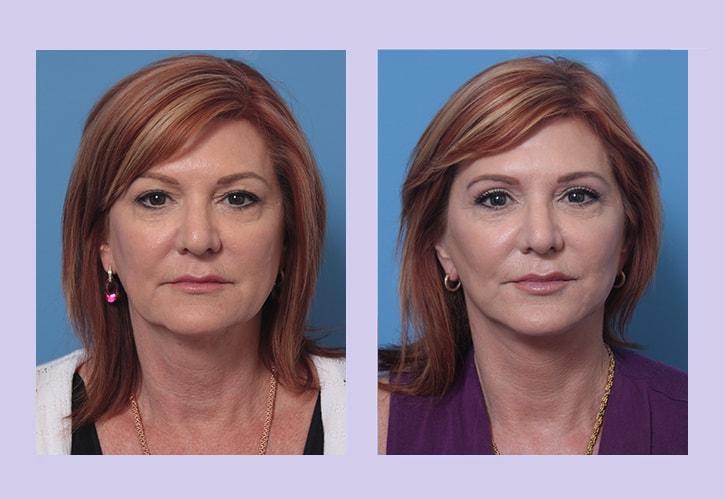 Dr. Anthony S. Youn, MD facelift result — Troy, MI