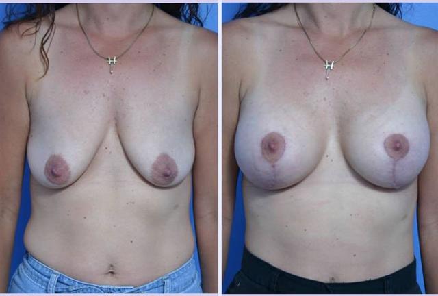 Breast Lift result at Dr. Anthony S. Youn, MD in Troy, MI
