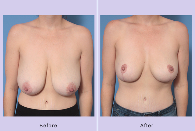 Breast Reduction result at Dr. Anthony S. Youn, MD in Troy, MI