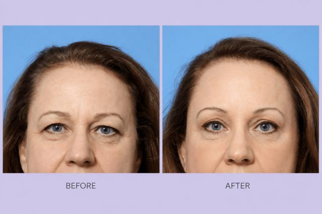 Brow Lift result at Dr. Anthony S. Youn, MD in Troy, MI