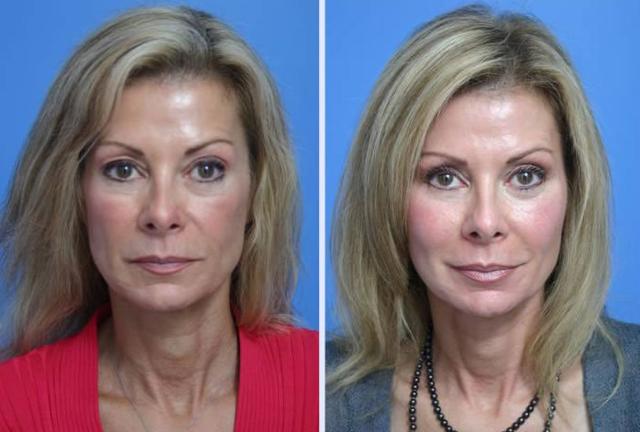 Fat Transfer result at Dr. Anthony S. Youn, MD in Troy, MI
