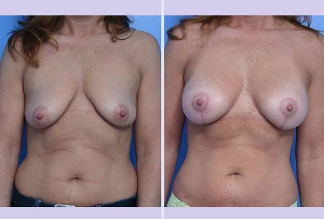 Breast Lift result at Dr. Anthony S. Youn, MD in Troy, MI