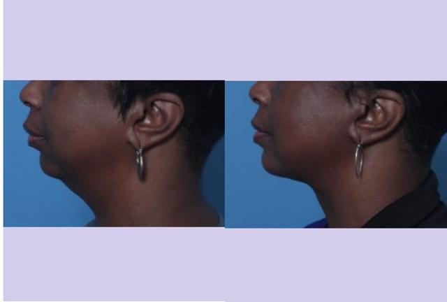 Chin Implant result at Dr. Anthony S. Youn, MD in Troy, MI