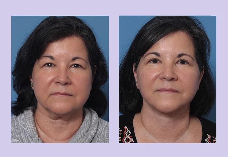 Dr. Anthony S. Youn, MD facelift result — Troy, MI