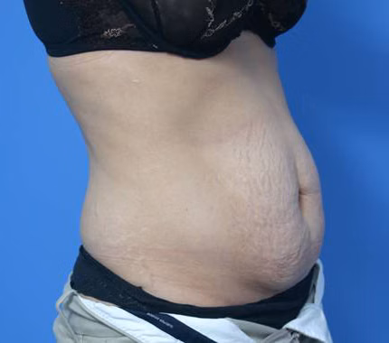Mini Tummy Tuck before at Dr. Anthony S. Youn, MD in Troy, MI