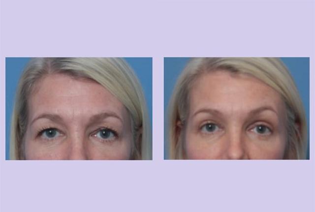 Blepharoplasty result at Dr. Anthony S. Youn, MD in Troy, MI