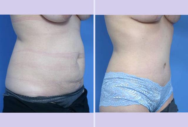 Tummy Tuck result at Dr. Anthony S. Youn, MD in Troy, MI