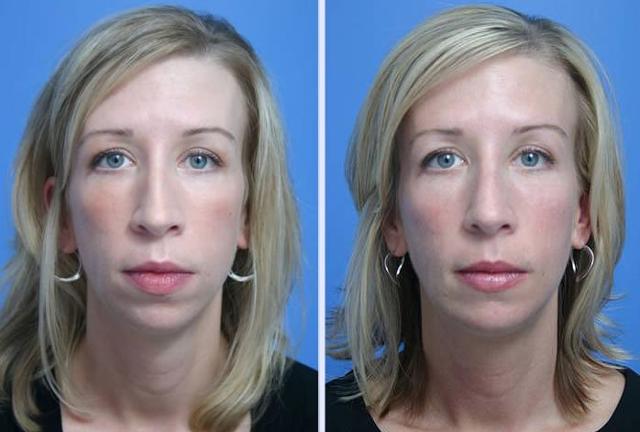 Chin Implant result at Dr. Anthony S. Youn, MD in Troy, MI