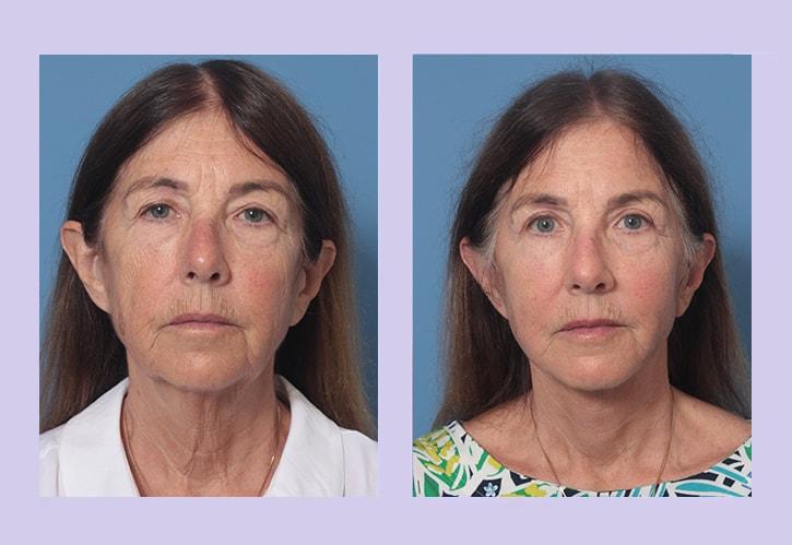 Dr. Anthony S. Youn, MD facelift result — Troy, MI
