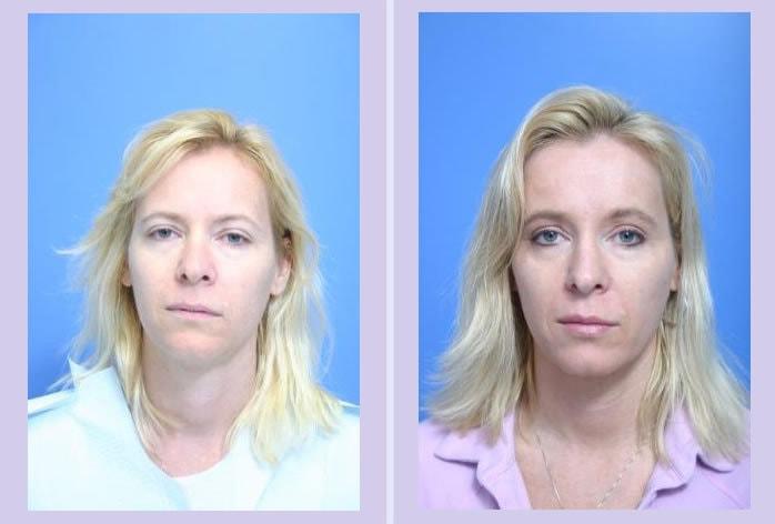 Dr. Anthony S. Youn, MD fat transfer result — Troy, MI