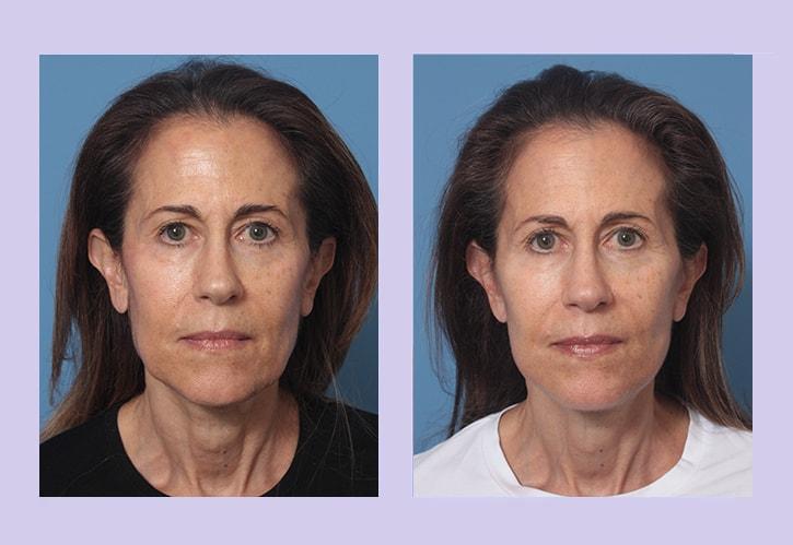 Dr. Anthony S. Youn, MD facelift result — Troy, MI