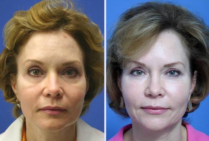 Dr. Anthony S. Youn, MD fat transfer result — Troy, MI
