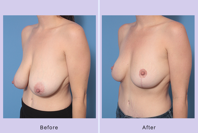 Breast Reduction result at Dr. Anthony S. Youn, MD in Troy, MI
