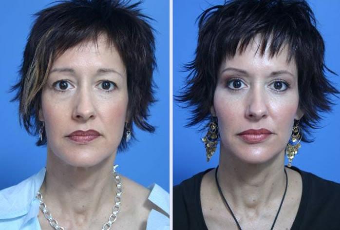 Dr. Anthony S. Youn, MD fat transfer result — Troy, MI