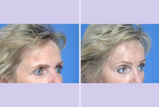 Brow Lift result at Dr. Anthony S. Youn, MD in Troy, MI