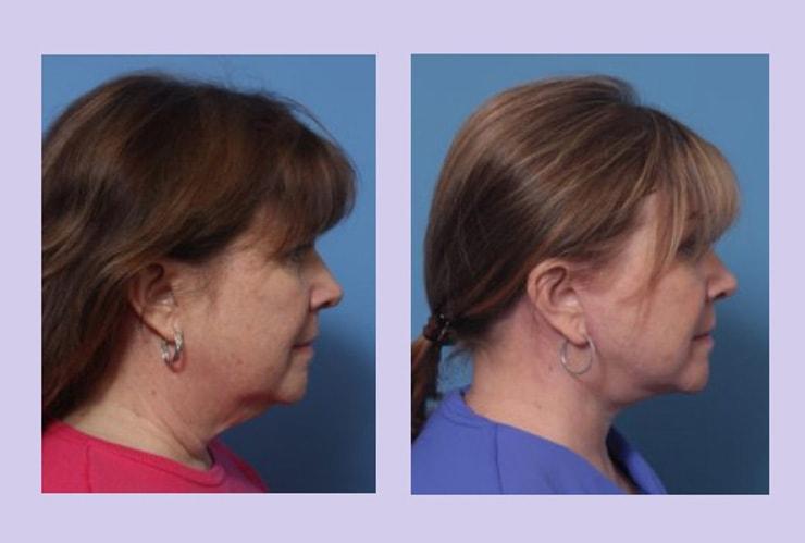 Dr. Anthony S. Youn, MD facelift result — Troy, MI