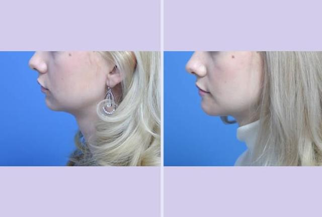 Chin Implant result at Dr. Anthony S. Youn, MD in Troy, MI