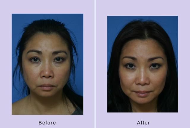 Chin Implant result at Dr. Anthony S. Youn, MD in Troy, MI