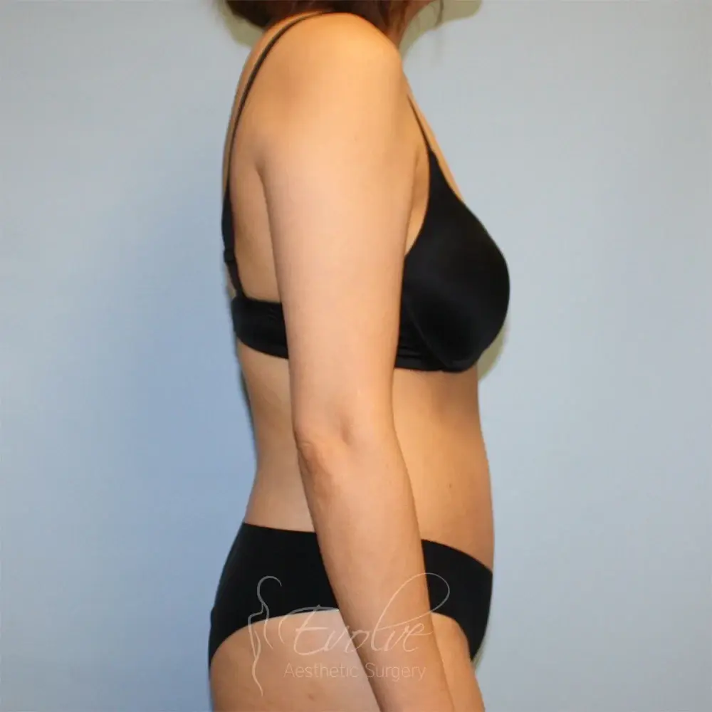 Evolve Aesthetic Surgery tummy tuck after — San Diego, CA