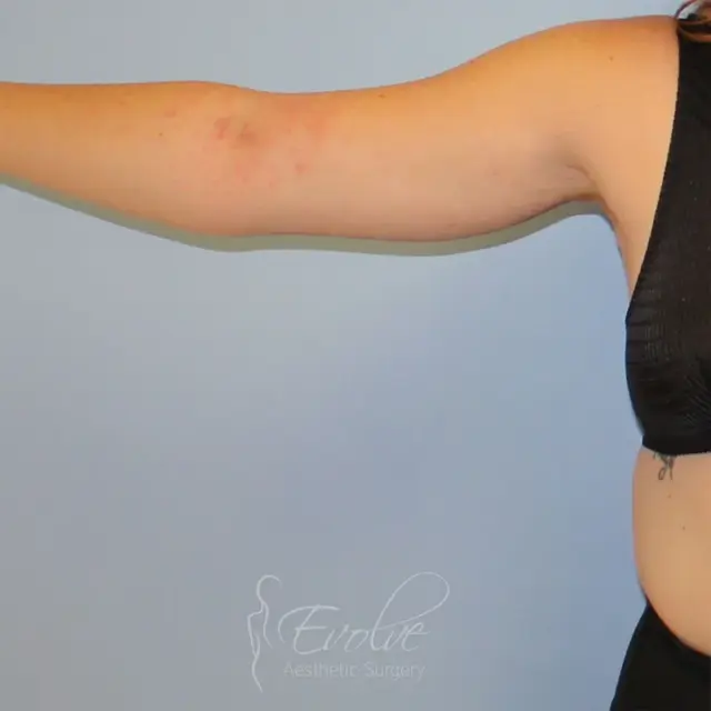 Arm Lift after at Evolve Aesthetic Surgery in San Diego, CA
