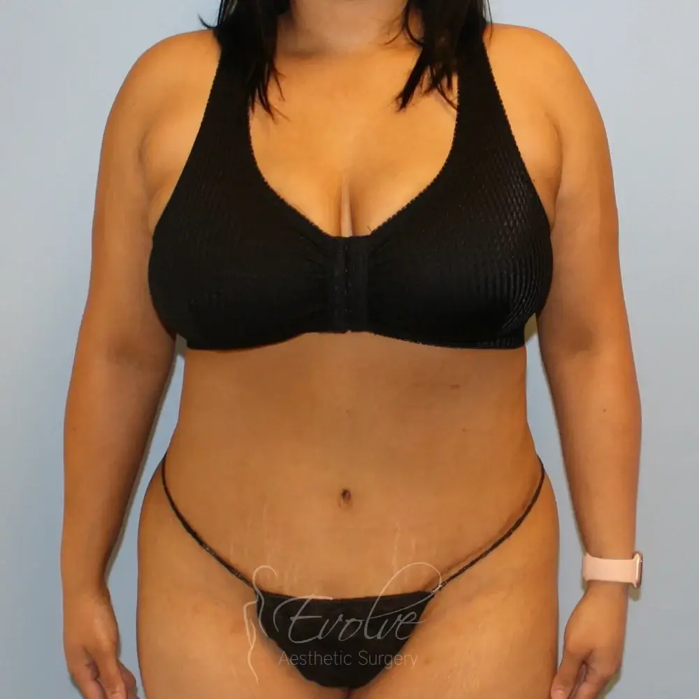 Evolve Aesthetic Surgery tummy tuck after — San Diego, CA