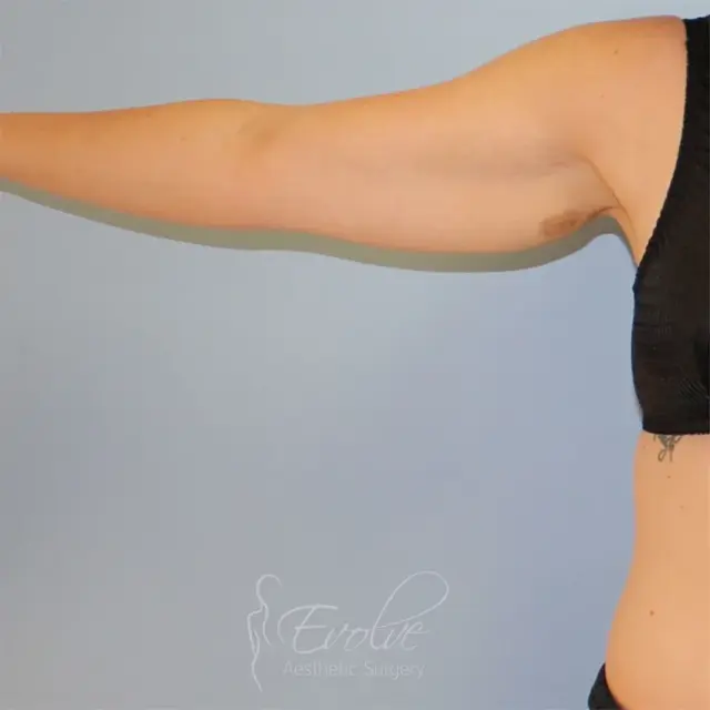 Arm Lift before at Evolve Aesthetic Surgery in San Diego, CA
