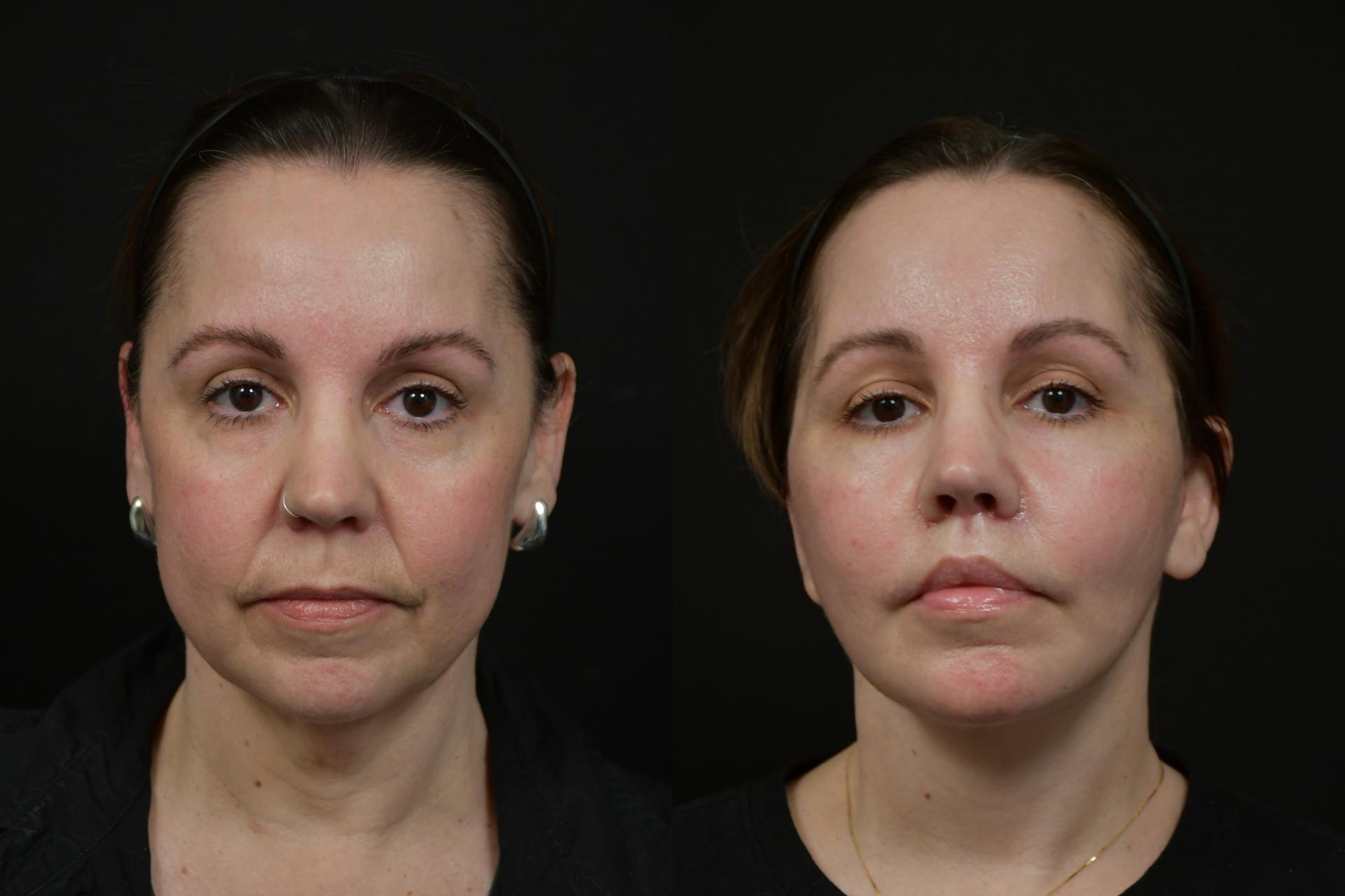 Michael T. Rossi, MD lip lift result — San Diego, CA