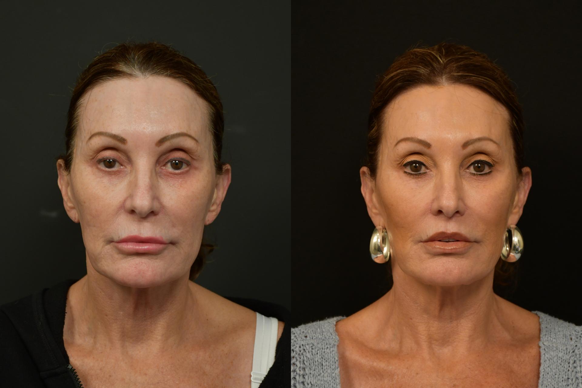 Michael T. Rossi, MD lip lift result — San Diego, CA