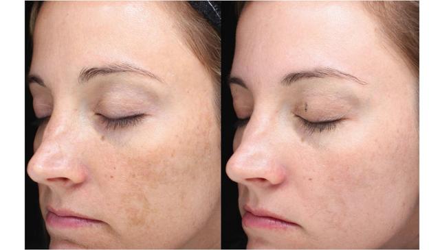Liquid BBL result at Face Forward Medical Aesthetics in Lexington, MA
