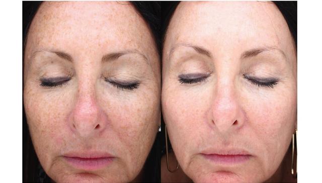 Laser Skin Resurfacing result at Face Forward Medical Aesthetics in Lexington, MA