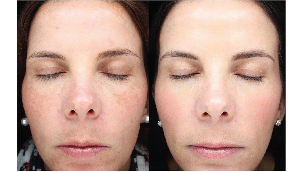 Face Forward Medical Aesthetics photofacial result — Lexington, MA