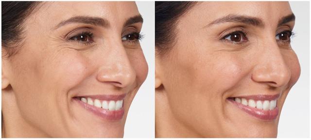 Liquid BBL result at Face Forward Medical Aesthetics in Lexington, MA