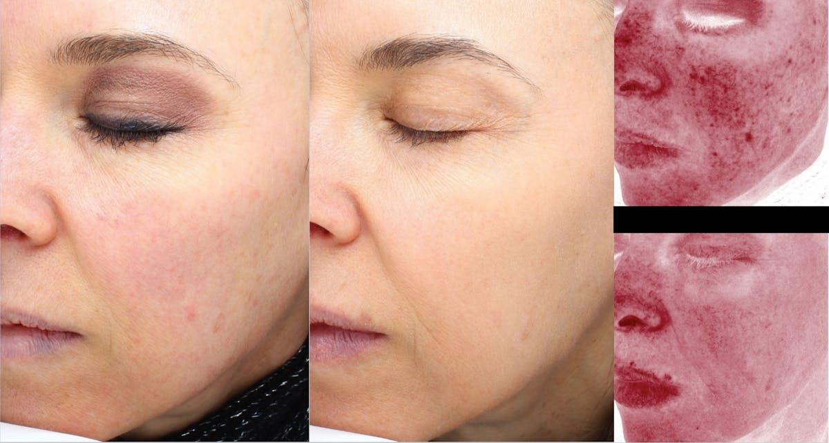 Face Forward Medical Aesthetics photofacial result — Lexington, MA