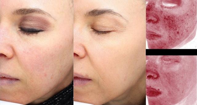 Laser Skin Resurfacing result at Face Forward Medical Aesthetics in Lexington, MA