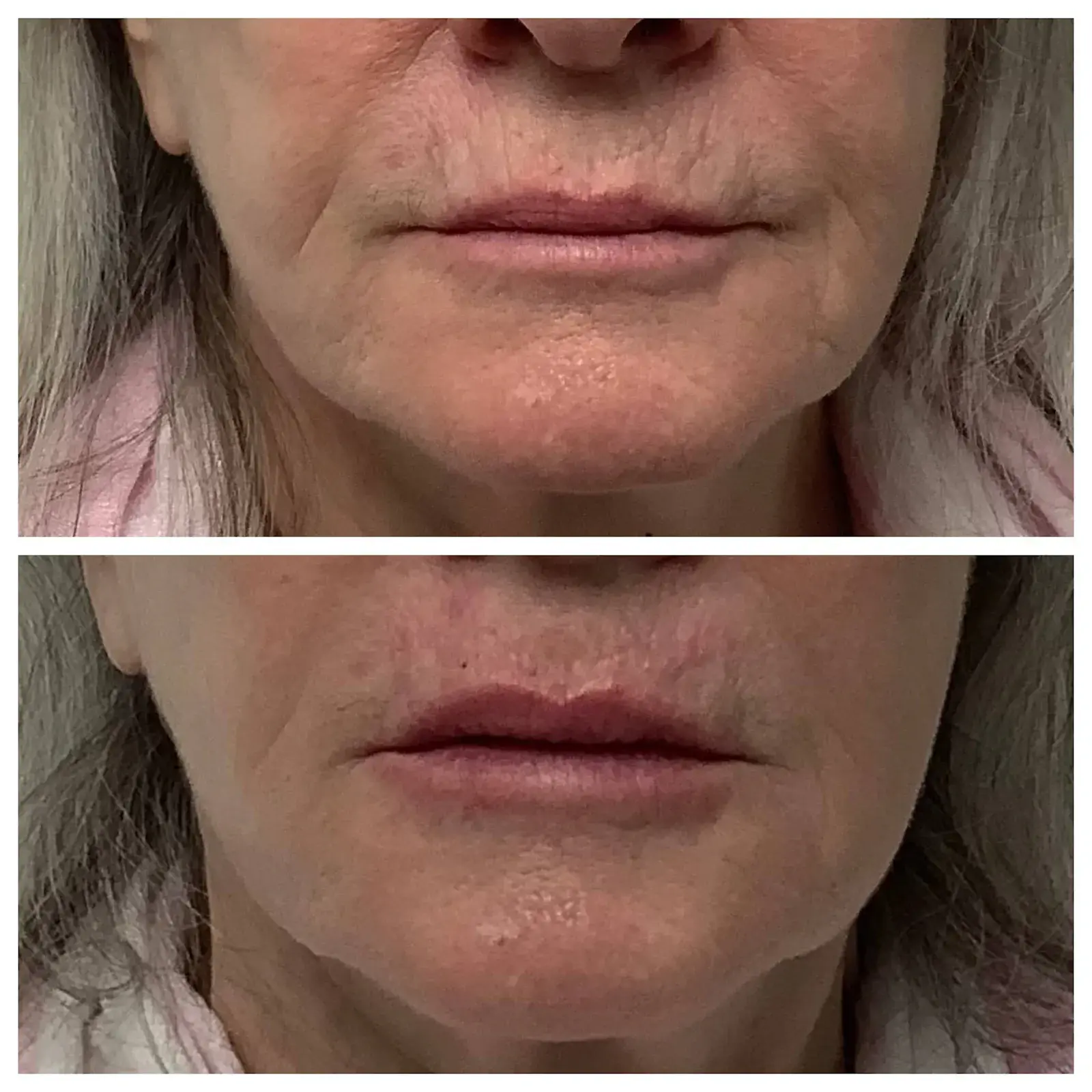 Face Forward Medical Aesthetics lip filler result — Lexington, MA