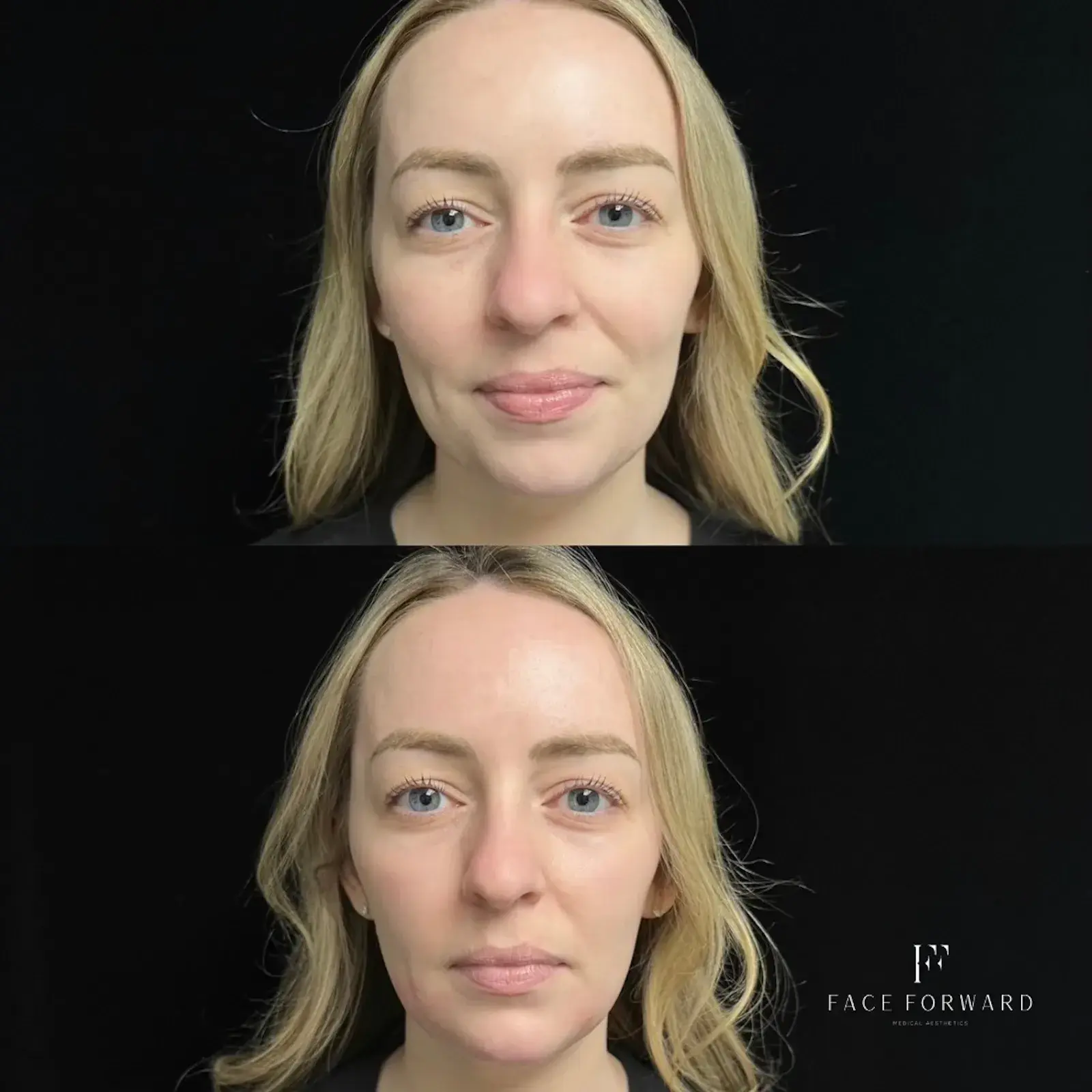 Face Forward Medical Aesthetics jawline filler result — Lexington, MA