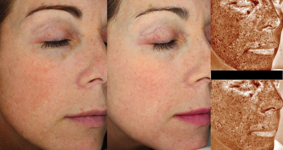 Face Forward Medical Aesthetics photofacial result — Lexington, MA