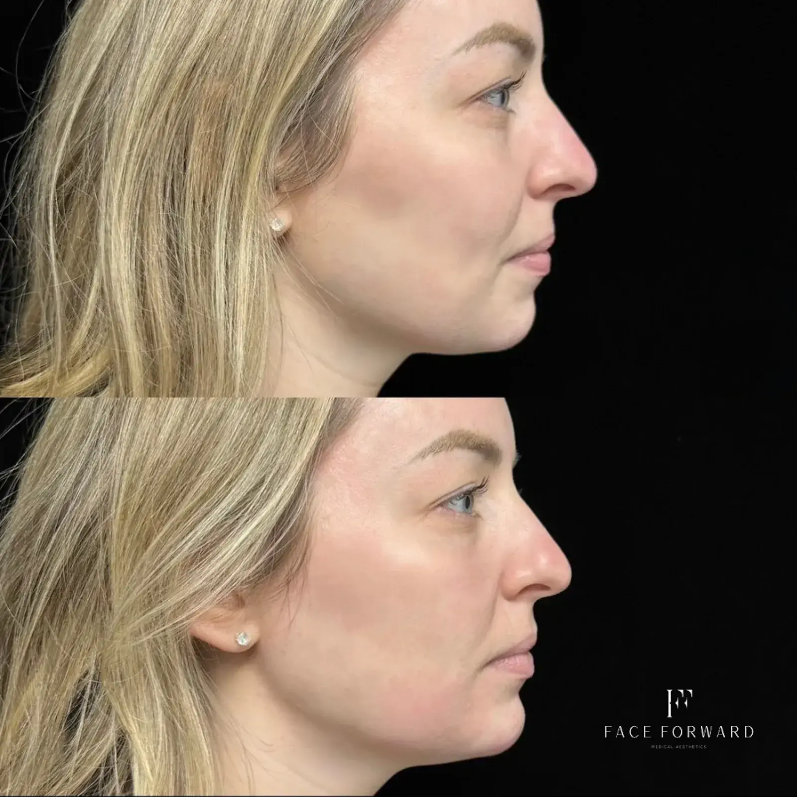 Face Forward Medical Aesthetics jawline filler result — Lexington, MA