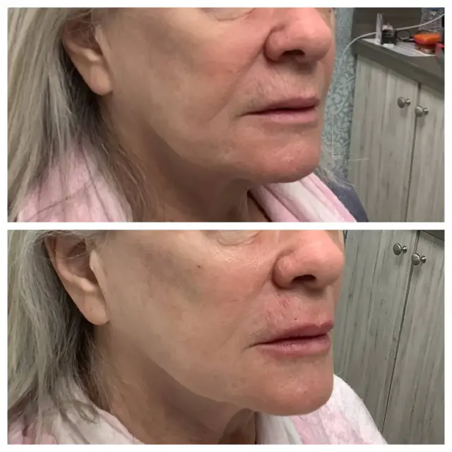 Jawline Filler result at Face Forward Medical Aesthetics in Lexington, MA