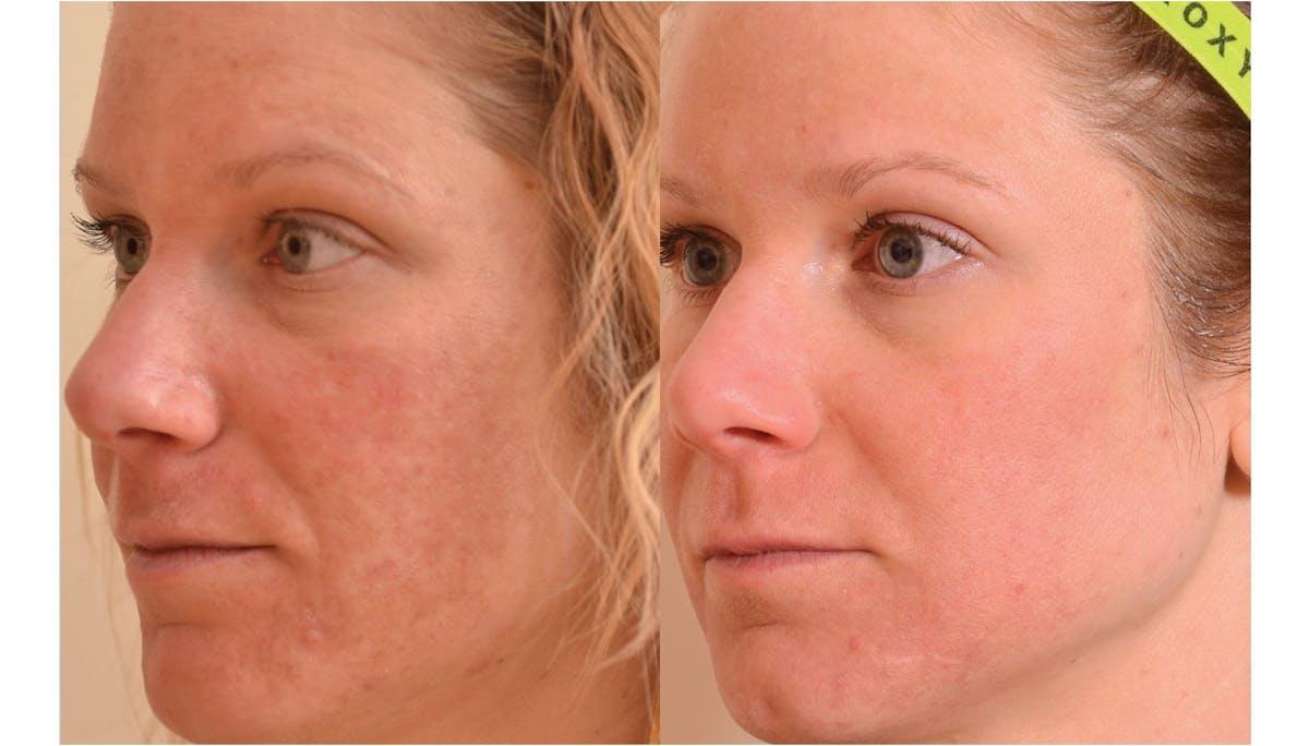 Face Forward Medical Aesthetics photofacial result — Lexington, MA