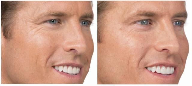 Liquid BBL result at Face Forward Medical Aesthetics in Lexington, MA