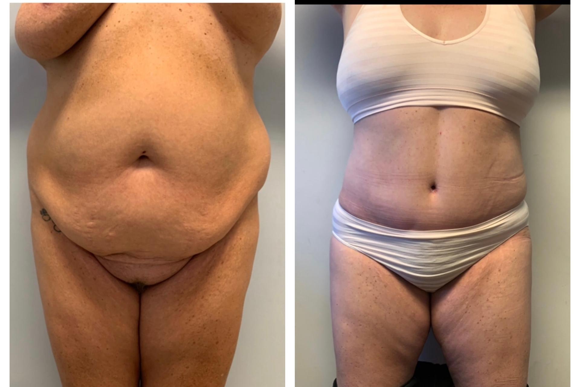 Chicago Institute of Plastic Surgery tummy tuck result — South Barrington, IL