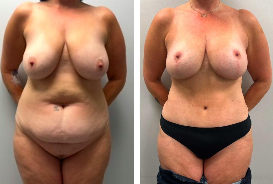 Chicago Institute of Plastic Surgery mommy makeover result — South Barrington, IL