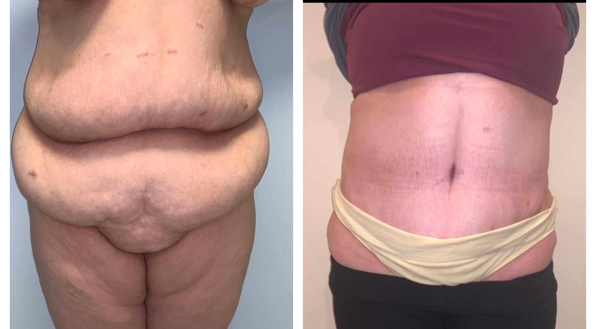 Chicago Institute of Plastic Surgery tummy tuck result — South Barrington, IL