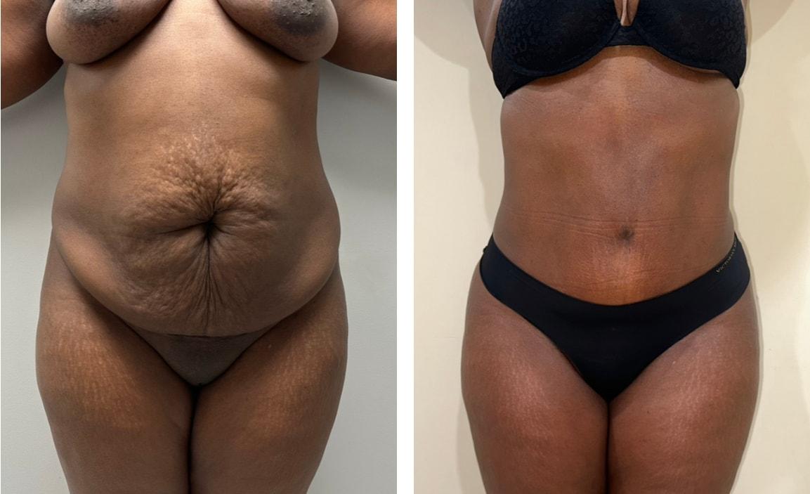 Chicago Institute of Plastic Surgery tummy tuck result — South Barrington, IL