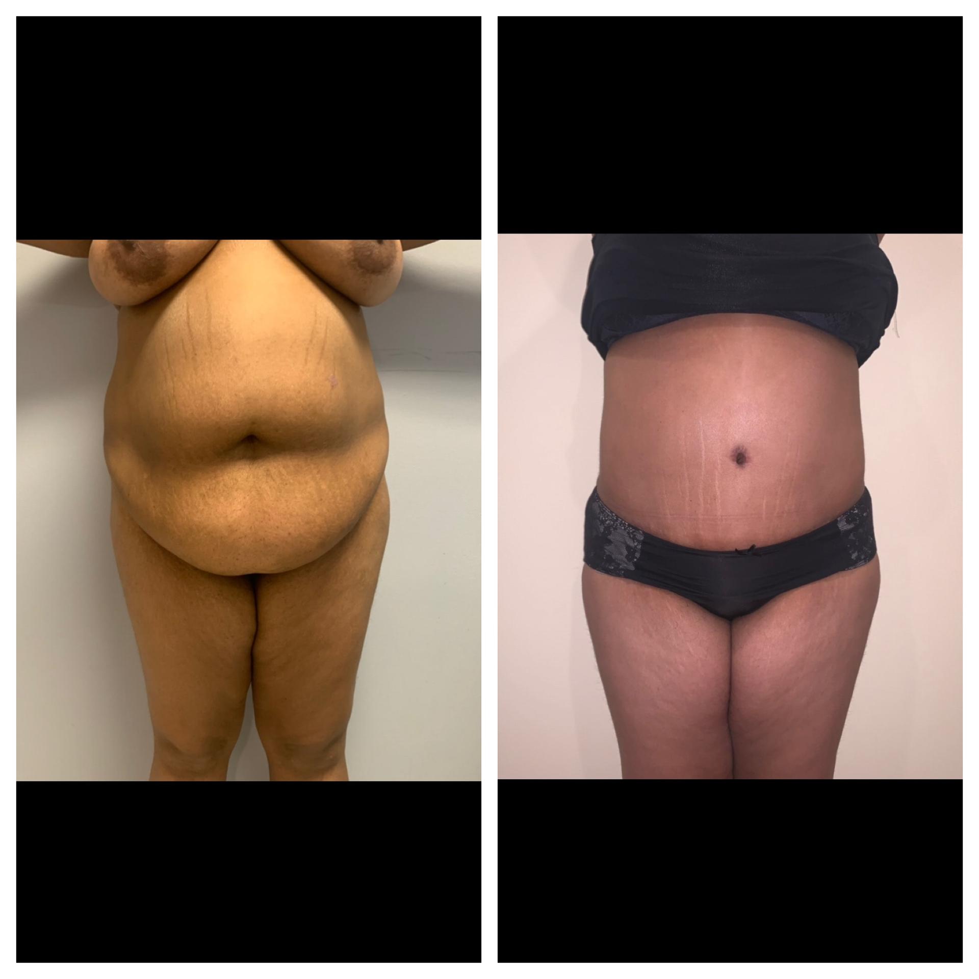 Chicago Institute of Plastic Surgery tummy tuck result — South Barrington, IL