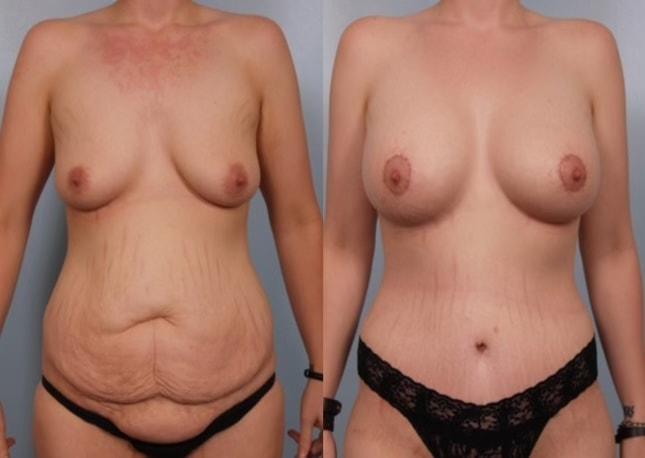 Chicago Institute of Plastic Surgery mommy makeover result — South Barrington, IL