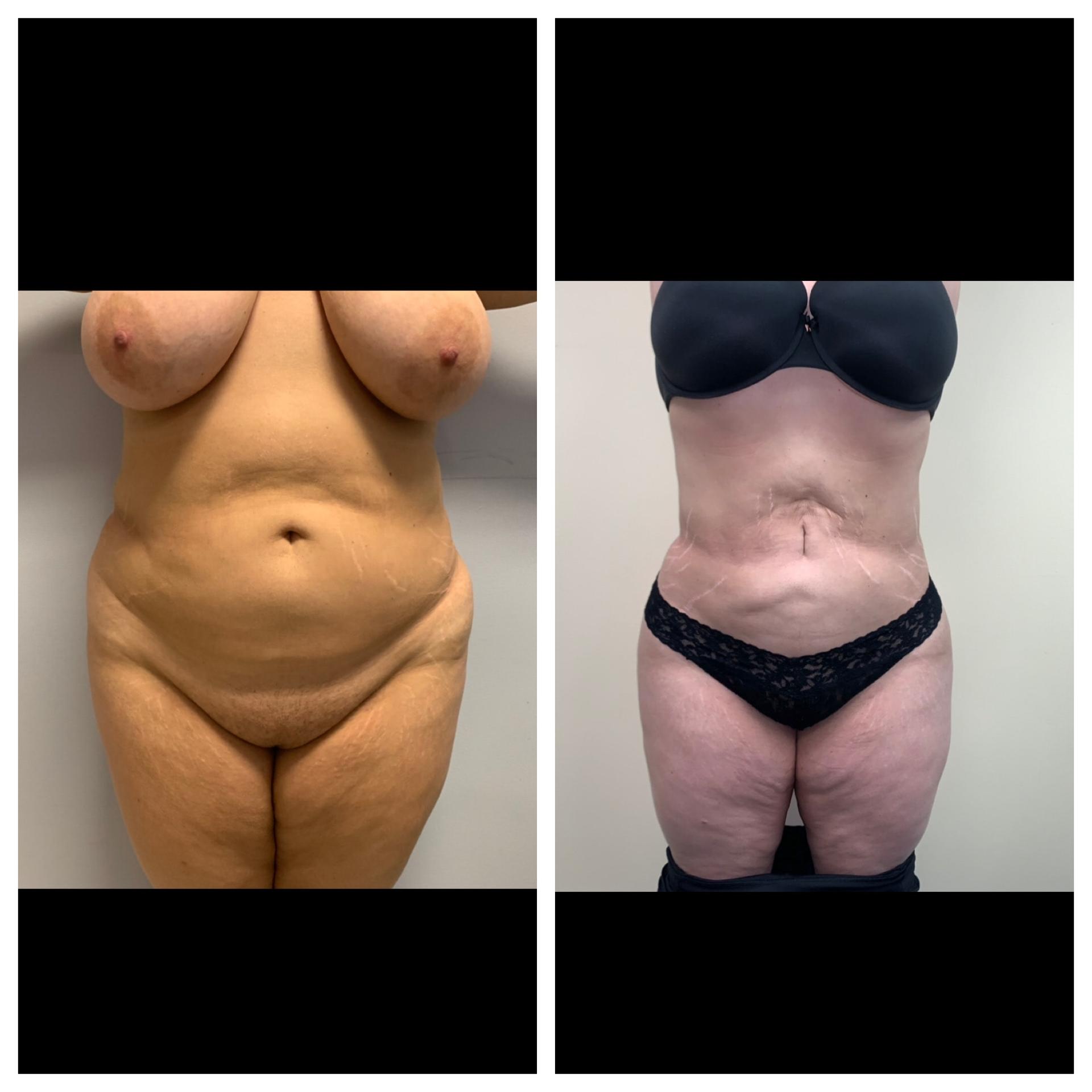Chicago Institute of Plastic Surgery tummy tuck result — South Barrington, IL