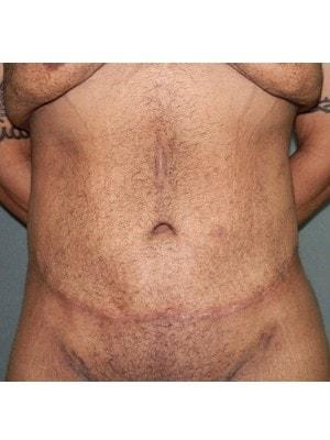Scot Bradley Glasberg, MD body contouring after — New York, NY